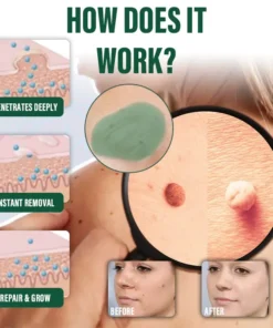 Ceoerty® DermaErase Instant Mole & Spot Remover Gel