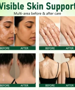 Ceoerty® Herbal Vitiligo Cream